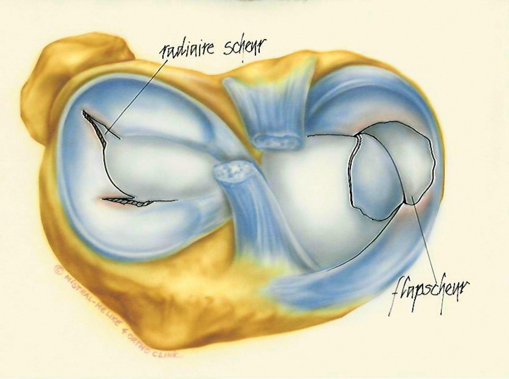 Meniscusscheur | Orthoclinic Brugge
